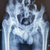 Total Hip Arthroplasty in Lubumbashi (DR Congo), Outcomes in a Resource-Limited Setting