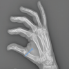 When Fat Takes Over: A Progressively Enlarging Giant Hand Lipoma