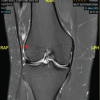 Synovial Sarcoma Disguised as a Ganglion Cyst in a Patient with Chronic Knee Pain