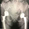 Successful Staged Bilateral Hip and Knee Arthroplasty in a Patient with Long-standing Rheumatoid Arthritis with Severe Deformities