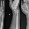 Bridge over Troubled Tendon? A Novel Case of Heterotopic Ossification of Lister’s Tubercle Causing Extensor Pollicis Longus Tenosynovitis