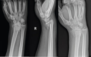 Figure 1: Plain radiographs injury films: Initial posteroanterior, lateral, and oblique radiographs of the right wrist at the time of injury demonstrating a distal radius fracture.