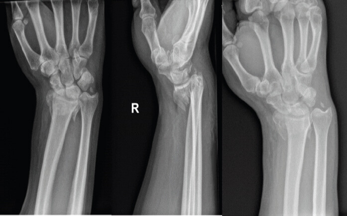 Figure 1: Plain radiographs injury films: Initial posteroanterior, lateral, and oblique radiographs of the right wrist at the time of injury demonstrating a distal radius fracture.