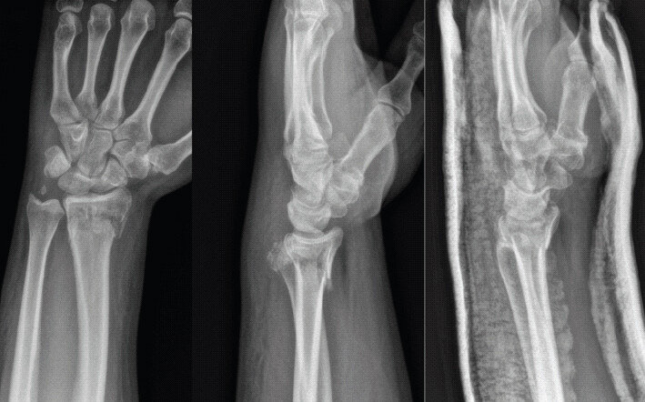 Figure 2: Post-reduction: Post-reduction posteroanterior and lateral and post-splint lateral radiographs of the right wrist obtained in the emergency department after closed reduction and splinting.