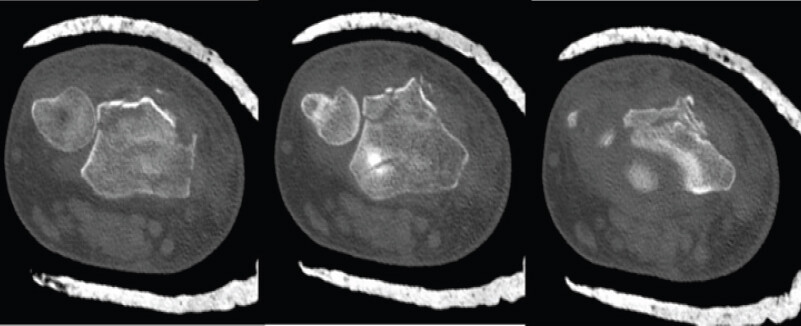 Figure 3: Axial computed tomography cuts post closed reduction and splinting in the enforcement directorate demonstrating fracture extension to the dorsal cortex and through Lister’s tubercle with comminution without entrapment of the extensor pollicis longus tendon within fracture.