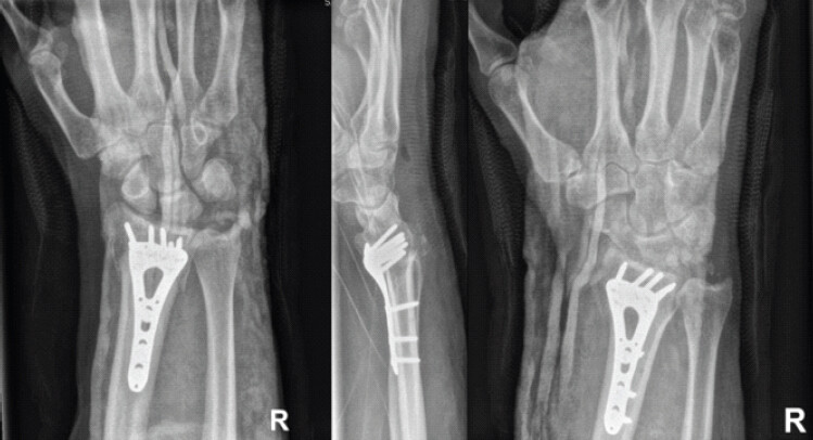 Figure 4: Initial post-operative open reduction internal fixation: Posteroanterior, lateral, and oblique radiographs obtained postoperatively of open reduction internal fixation without signs of hardware complication. Significant dorsal comminution is present.