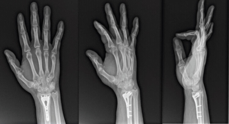 Figure 5: Posteroanterior, lateral, and oblique radiographs 23 months postoperatively demonstrating intact hardware from open reduction internal fixation with mild heterotopic ossification formation of the dorsal radius.