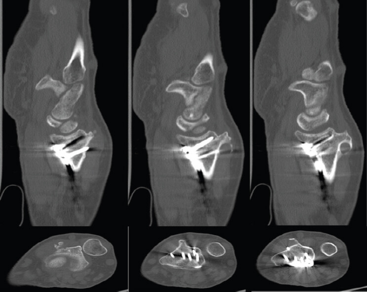 Figure 6: Representative sagittal and axial cuts of computed tomography demonstrating prominent screw in the metaphysis of the distal radius along with a heterotopic ossification that is formed over the Lister’s tubercle with bridging bone. A volar screw also is extending beyond the dorsal cortex.