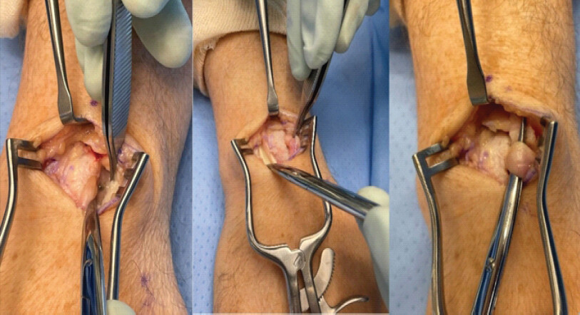 Figure 7: Intraoperative photographs: The extensor pollicis longus (EPL) tendon was visualized entering a tunnel created by bridging bone of heterotopic ossification extending from the area of Lister’s Tubercle with significant tenosynovitis of the EPL tendon, which was subsequently debrided.