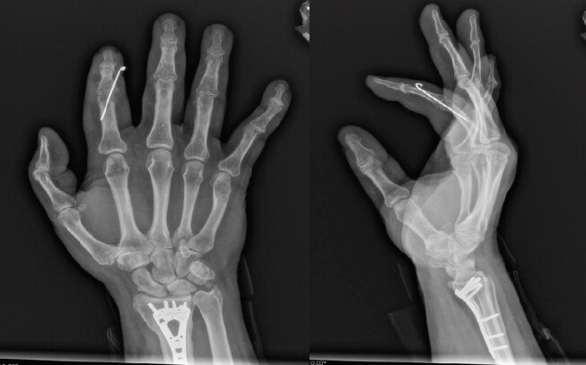 Figure 8: Post-operative posteroanterior and lateral radiographs demonstrating excision of heterotopic bone and removal of screw.