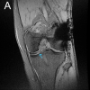 Bilateral Discoid Medial Menisci in a 52-Year-Old Adult: A Case Report