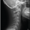 Temporary Fusionless Occipitocervical Fixation of Bilateral Occipital Condylar Avulsion Fractures in an Adult