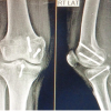 Posterior Approach for Single-stage Fixation of Medial Hoffa with Posterior Cruciate Ligament Avulsion: A Rare Case Report