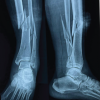 Management of Ipsilateral Tibia and Fibula Shaft Fracture with Trimalleolar Fracture: A Rare Case Report