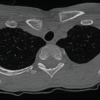 Spontaneous Remodeling of Posterior Sternoclavicular Joint Dislocations in Skeletally Immature Patients: A Case Report