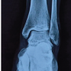A Displaced and Entrapped Anterior Malleolus (Tillaux Fragment) Causing an Irreducible Syndesmosis and Ankle Fracture–Dislocation in an Adolescent: A Case Report