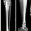 Suprapatellar Tibial Nailing in Skeletally Immature Patients: A Case Series