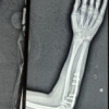 Failed Primary Fixation of Monteggia Fractures – A Case Series