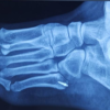 Surgical Management of Painful Os Vesalianum: A Case Report and Literature Review