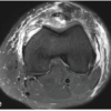 Bilateral Patellar Tendon and Unilateral Syndesmotic Injury in a Recreational Athlete