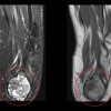 Young Female with Calcaneal Chondroblastoma & Secondary Aneurysmal Bone Cyst: Case Report