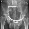 Intraoperative Diagnosis and Management of Testicular Dislocation During Pelvic Fracture Fixation: A Report of Two Cases and Literature Review