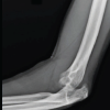 Surgical Treatment of Neglected Elbow Dislocation with the Box-loop Technique: A Case Report