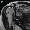Arthroscopy-Assisted Lower Trapezius Tendon Transfer Combined with Superior Capsular Reconstruction in Posterosuperior Irreparable Rotator Cuff Tears: A Case Report
