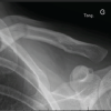 Medial Clavicle Fracture with Posterior Dislocation of the Ipsilateral Acromioclavicular Joint Following Skiing Trauma