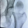 Osteosynthesis in Iatrogenic Femoral Neck Fracture following Irreducible Posterior Hip Fracture Dislocation in an Elderly Patient: A Case Report and Literature Review