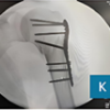 Outcomes of Proximal Humeral Fracture Fixation Using Minimally Invasive Plate Osteosynthesis: A Prospective Clinical and Radiographic Study