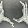 Cleft Hand and Foot Syndrome: A Report of Three Cases with Review of Literature