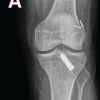 Single Stage Revision Anterior Cruciate Ligament Reconstruction through Anterolateral Tunnel in a Significantly Widened Tibial Tunnel using Peroneus Longus Tendon Autograft – A Case Report