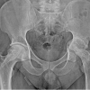 Case Report on Steroid-induced Bilateral Femoral Head Osteonecrosis with Concomitant Hip Septic Arthritis in Primary Membranous Nephropathy
