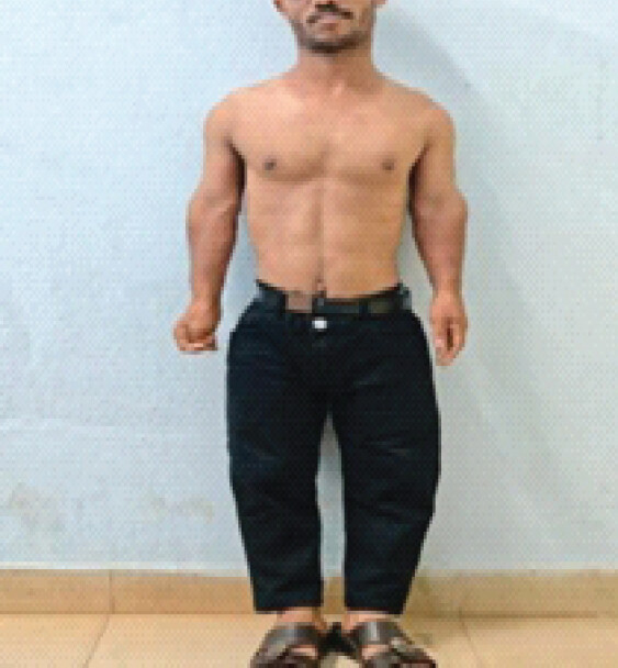 Figure 1: Rhizomelic limb shortening (shortening of proximal segment) in Achondroplasia.