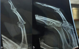 Figure 1: Pre-operative radiographs of the right ring finger. (a) Anteroposterior and (b) lateral radiographs demonstrating the chronic proximal interphalangeal (PIP) joint fracture-dislocation with a volar articular defect at the base of the middle phalanx and associated loss of PIP joint congruity.