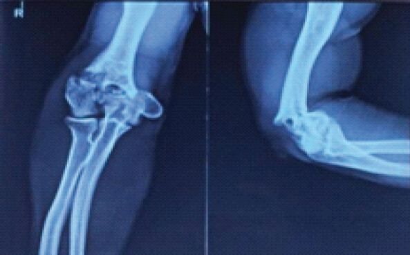 Figure 2: X-ray elbow antero-posterior and lateral showing articular comminution and metaphyseal involvement.