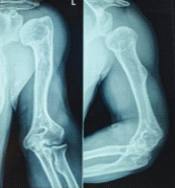 Figure 3: X-ray Antero-posterior and Lateral views of the opposite side humerus in the patient showing metaphyseal deformity and abnormal bone geometry, used as a template for fracture fixation on the affected side.