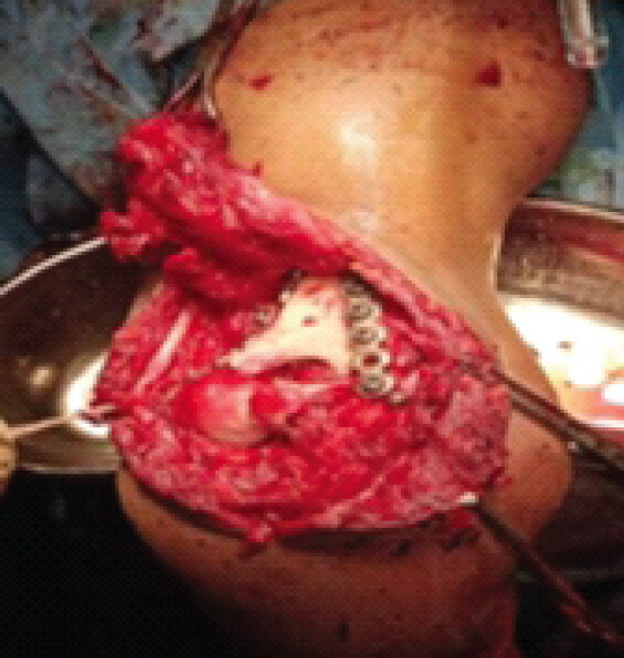 Figure 4: Distal humerus after olecranon osteotomy, fixation done with dual 3.5-mm reconstruction plates perpendicular to each other contoured to match the shortened, angulated distal humerus anatomy. Ulnar nerve is mobilized and tagged to prevent injury.