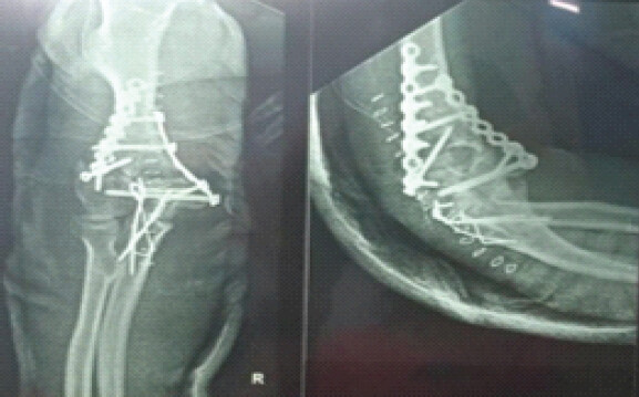Figure 5: Post-operative X-ray elbow showing perpendicular plating with 3.5 mm reconstruction plates. 4 mm cannulated cancellous screws were used to hold the intercondylar segment and comminuted fragment in the lateral condyle of the humerus. Tension band wiring was done for the olecranon osteotomy.