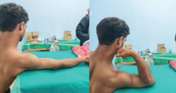 Figure 6: Range of movements 5 months postoperatively.