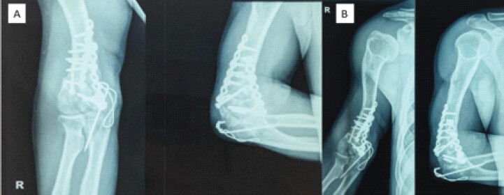 Figure 7: Post-operative X-rays of elbow (A) and humerus (B) taken 5 months post-operatively