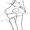 Oblique Lateral Closing-Wedge Osteotomy for Cubitus Varus in Skeletally Immature Children: A Case Series