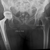 Minimally Invasive Prophylactic Plating for Bisphosphonate-induced Atypical Femoral Fracture Post Total Hip Replacement