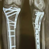 Radiological and Functional Assessment of Tibial Plateau Fractures Managed with Locking Compression Plates: A Prospective Study