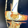 3D Computed Tomography-Guided Management of Retained Surgical Drain in Total Knee Arthroplasty: A Case Report and Technical Note