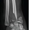 Nonvascularized Iliac Crest Autograft for Wrist and Hand Reconstructions: A Report of Two Clinical Cases and Literature Review