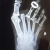 Closed Traumatic Dislocation of 2nd–4th Metatarsophalangeal Joints with Associated 5th Metatarsal Base Fracture: A Rare Case Report
