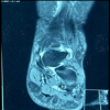 Soft-tissue Leiomyoma in a Rare Location: The Achilles Tendon