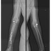 A Unique Case of Bilateral Elbow Terrible Triad in a Polytrauma Patient: Associated Challenges in Management